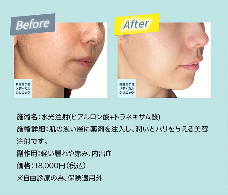水光注射(ヒアルロン酸+トラネキサム酸) BeforeAfter
