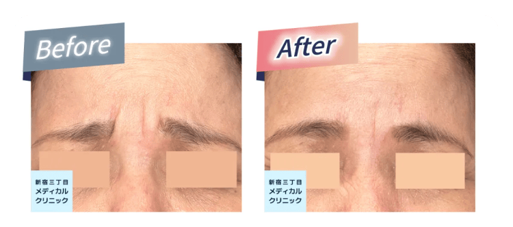 ボトックス注射の施術前(Before)と施術後(After)の額のシワ